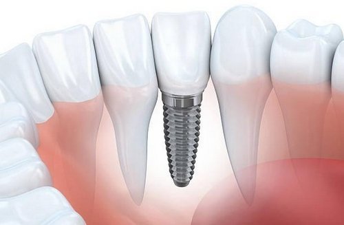 Dental implant