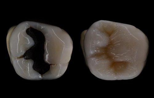 4b. porselen dolgu 2 Porselen Dolgu Nedir?